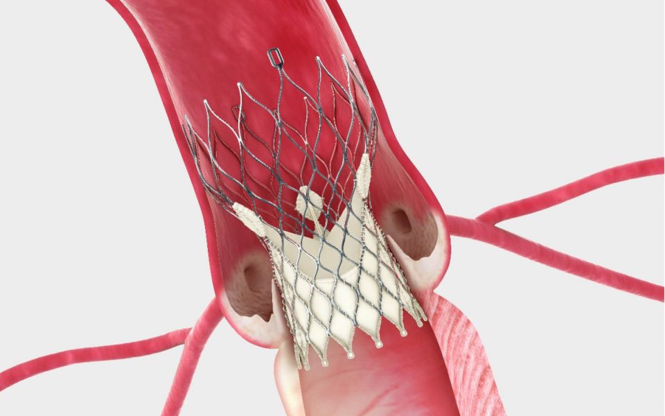 A Patient's Story: Charanjit Singh on Living with Aortic Stenosis and His TAVI Journey